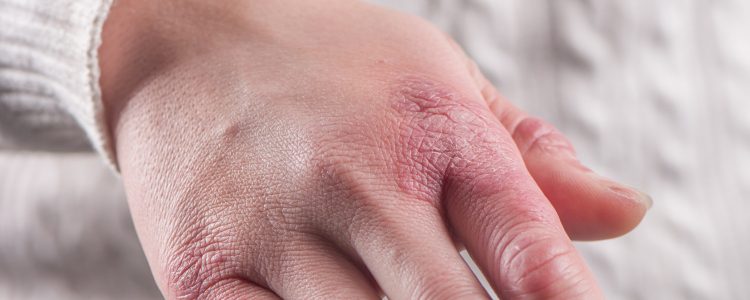 Close-up of chapped hand showing severe chilblain inflammation symptoms
