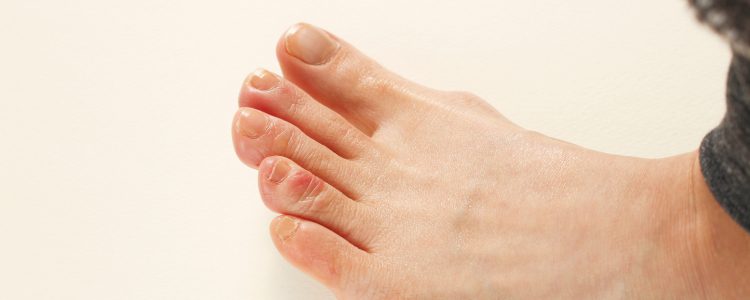 Close-up of foot showing red inflamed toes with chilblains
