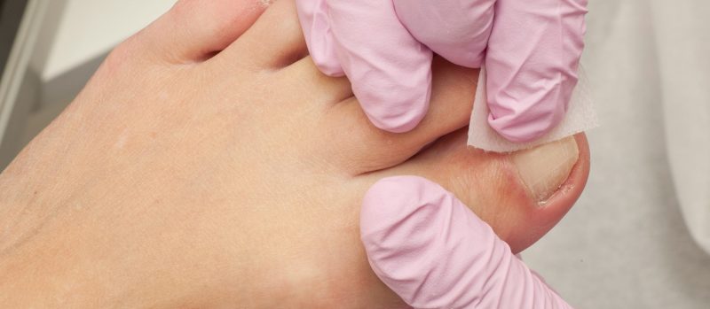 Ingrown Toe Surgery