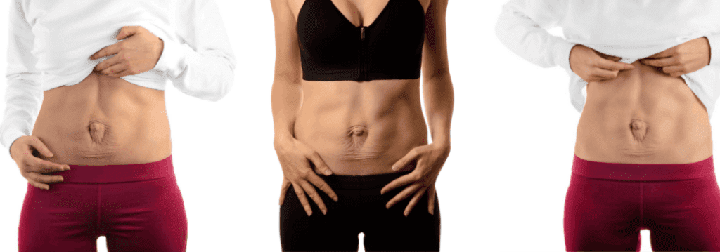 Abdominal Separation and Pregnancy