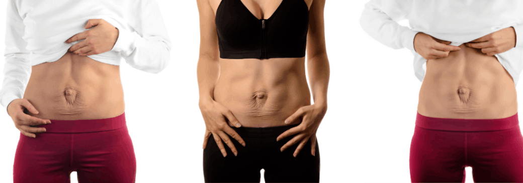 Abdominal Separation and Pregnancy - Central Coast Physiotherapy