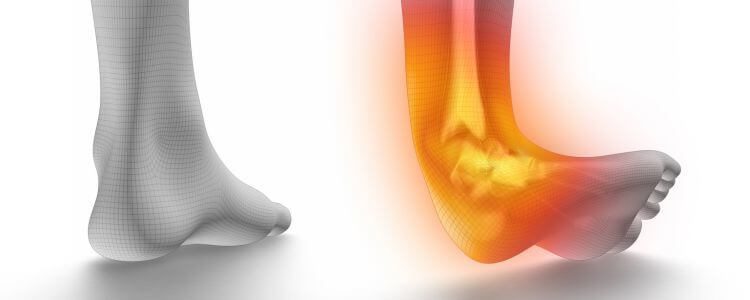 A graphic showing the side view of an ankle, with a highlight of red and orange colours around the joint, indicating pain and inflammation associated with an ankle sprain.