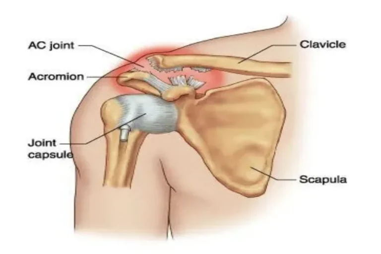AC joint anatomy showing the clavicle, acromion and scapula