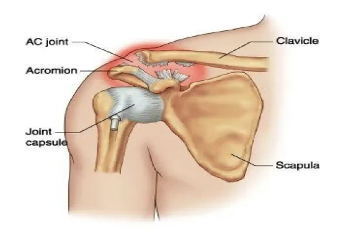 AC joint anatomy showing the clavicle, acromion and scapula