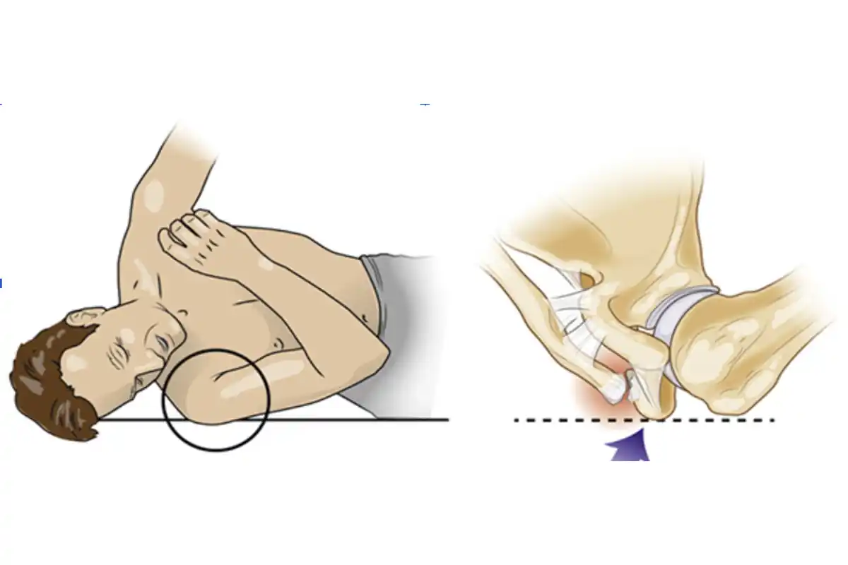 Falling onto the side of the shoulder, the most common mechanism of AC joint injury