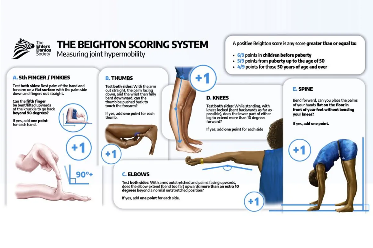 Beighton scoring system for measuring joint hypermobility